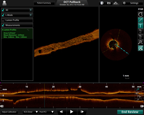 3-D image of a stent inside a coronary artery taken using the ILUMIEN(TM) OPTIS(TM) (Photo: St. Jude ...
