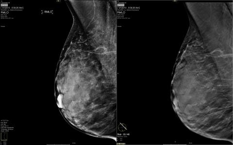 The breast image on the left shows a 2D RMLO (right mediolateral oblique) view compared to a digital ... 