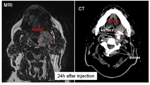 Figures: Patient treated with NBTXR3; MRI (visualization of the tumor) and CT Scan (visualization of ... 