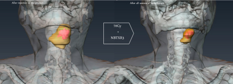 Figure: Patient treated with NBTXR3; 3D scan reconstruction before and after radiotherapy, showing t ... 