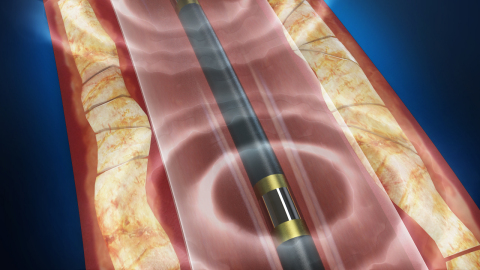 Shockwave Medical's Lithoplasty® System for the treatment of calcified plaque in patients with perip ... 