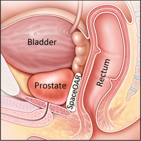 SpaceOAR separates the prostate and rectum during radiation treatment, reducing rectal injury (Graph ... 