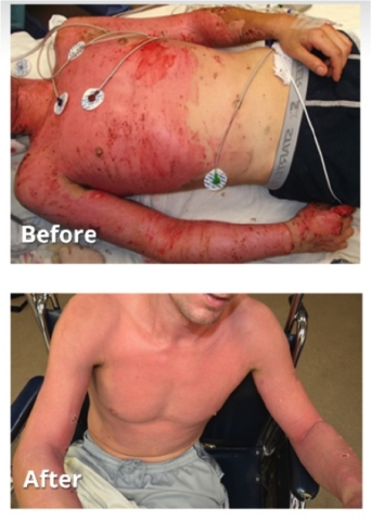 Burn patients treated with technology behind RenovaCare SkinGun(TM). Source: Burns, Journal of the I ... 