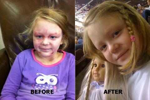 Jason International's oxygen bath provides natural relief from Eczema for nine-year-old from Arkansas.