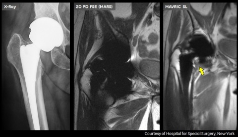 MAVRIC SL demonstrates evidence of an abnormal synovial response indicative of an adverse tissue reaction (arrow). Disclaimers: These images were generated using the MAVRIC SL software feature and are representative of the quality of images that users should expect to generate. However, GE Healthcare is not always able to confirm whether the images are of MR Conditional implants or whether scanning was in accordance with the implant's instructions for use. MAVRIC SL should only be used with MR Conditional implants and within the MR conditions specified for those implants. (Photo: Business Wire)