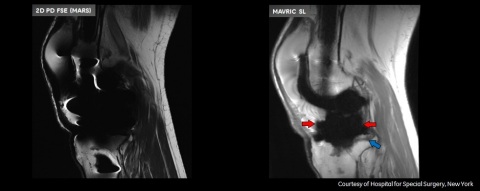 Note visualization of bone interface around the femur (red arrow), and posterior tibial osteolysis (blue arrow) on the MAVRIC SL image (right). MAVRIC demonstrates clear outline of polyethylene (red arrows) and posterior tibial osteolysis (blue arrow). Disclaimers: These images were generated using the MAVRIC SL software feature and are representative of the quality of images that users should expect to generate. However, GE Healthcare is not always able to confirm whether the images are of MR Conditional implants or whether scanning was in accordance with the implant's instructions for use. MAVRIC SL should only be used with MR Conditional implants and within the MR conditions specified for those implants. (Photo: Business Wire)