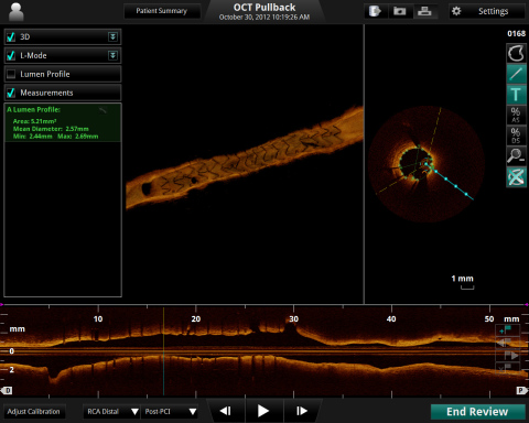3-D image of a stent inside a coronary artery taken using the ILUMIEN(TM) OPTIS(TM) (Photo: St. Jude Medical, Inc.)