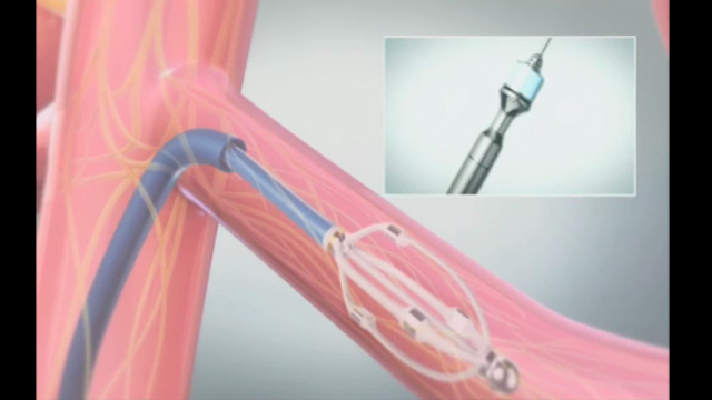 An animation of the next-generation EnligHTN(TM) Renal Denervation System, which delivers simultaneous ablations via a multi-electrode catheter, reducing ablation time from approximately 24 minutes to four minutes. Animation courtesy of St. Jude Medical