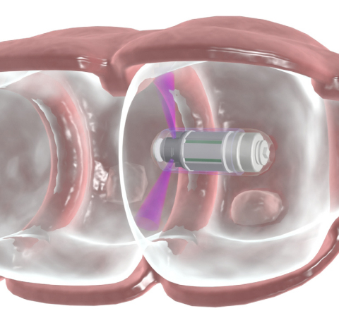 Check-Cap capsule advances through the colon, transmitting data reflecting the colon's internal surface. (Graphic: Business Wire) 