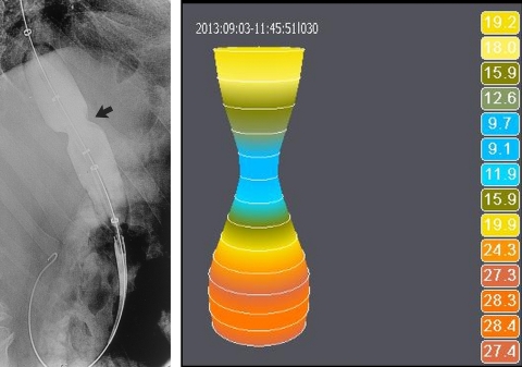 Comparison of standard fluoroscopic image (left) and EsoFLIP® image with diameter measurements (right) (Graphic: Business Wire)