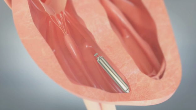 Animation demonstrating Nanostim(TM) leadless pacemaker implant procedure.