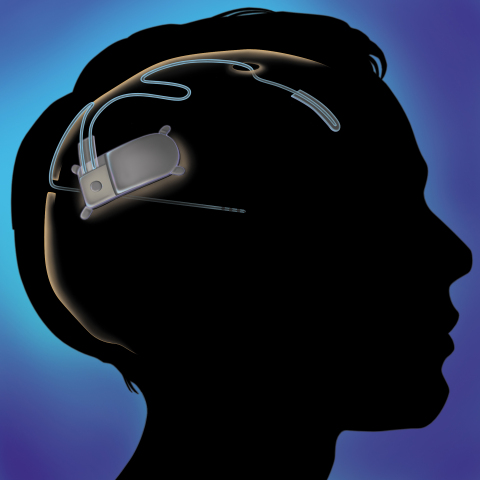 The RNS(R) System has been granted premarket approval (PMA) from the FDA for the treatment of adults with partial onset seizures that have not been controlled with two or more antiepileptic drugs. The RNS System is a novel, implantable therapeutic device that delivers responsive neurostimulation, an advanced technology designed to detect abnormal electrical activity in the brain and respond by delivering imperceptible levels of electrical stimulation to normalize brain activity before an individual experiences seizures. (Graphic: Business Wire)