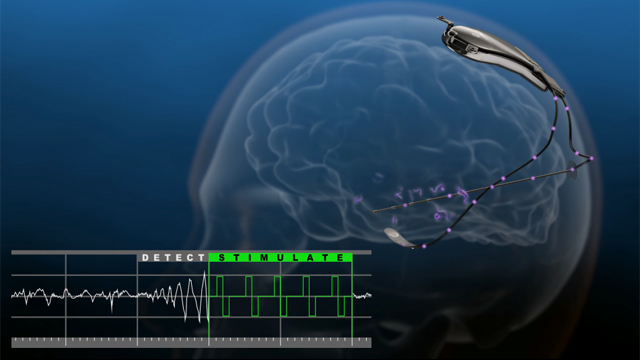 The RNS(R) System has been granted premarket approval (PMA) from the FDA for the treatment of adults with partial onset seizures that have not been controlled with two or more antiepileptic drugs. The RNS System is a novel, implantable therapeutic device that delivers responsive neurostimulation, an advanced technology designed to detect abnormal electrical activity in the brain and respond by delivering imperceptible levels of electrical stimulation to normalize brain activity before an individual experiences seizures.