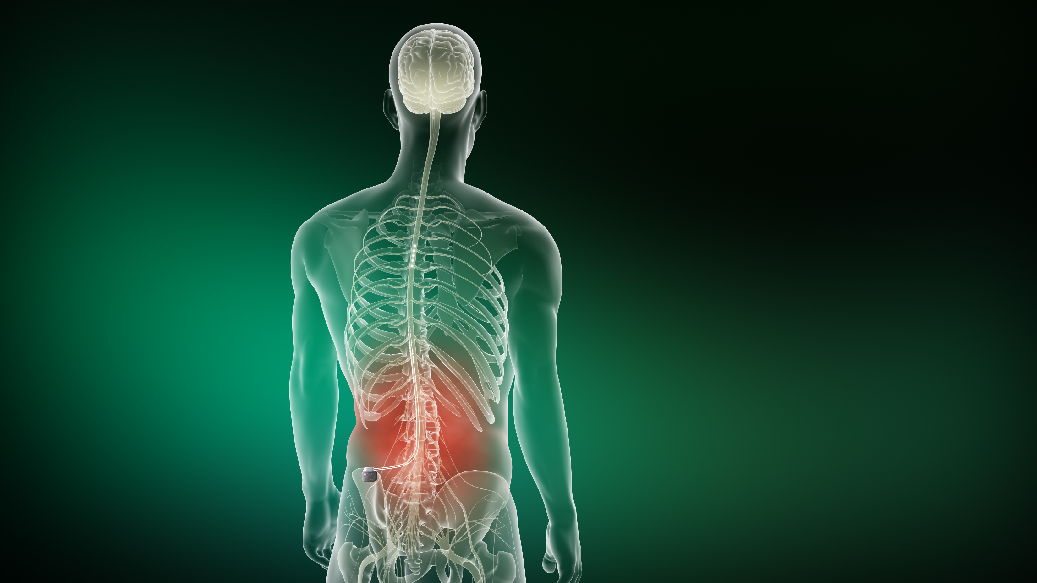 Spinal Cord Stimulator - Pain management clinics in Las Vegas