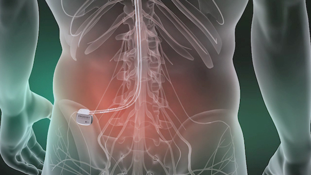 Animation of the Prodigy(TM) spinal cord stimulator being evaluated in the SUNBURST study. Caution Investigational device. Limited by Federal (or United States) law to investigational use. Animation provided by St. Jude Medical.
