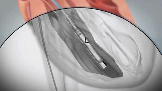 Animation demonstrating Nanostim™ leadless pacemaker implant procedure (Video: Business Wire)