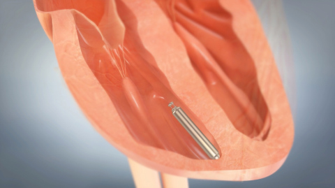 The Nanostim leadless pacemaker is designed to be implanted directly into the heart during a non-surgical procedure. (Photo: Business Wire)