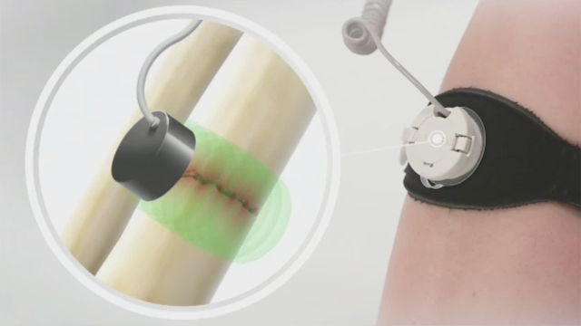 Video detailing the mechanism of action for the next generation of EXOGEN® Ultrasound Bone Healing System from Bioventus (Video: Business Wire)