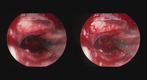 View in the sella, looking beyond the optic chiasm and lateral to the pituitary stalk, comparing the relatively low dynamic range of conventional technology (left) to the high dynamic range achieved with SPIES Chroma(TM) and SPIES Clara(TM) (right). (Photo: Business Wire)