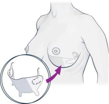 Successful Live Surgery with OrbiShape™ Breast Supporting System