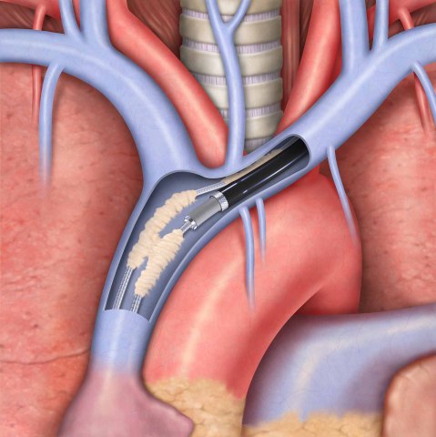 The distal end of the Evolution® RL sheath disrupting scar tissue around an implanted cardiac lead. (Graphic: Business Wire)