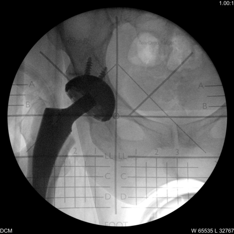 HipGrid Teardrop Target used during total hip replacement surgery. (Photo: Business Wire)