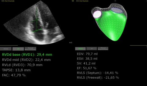 
4D RV-Function Right ventricular Analysis (Photo: Business Wire)