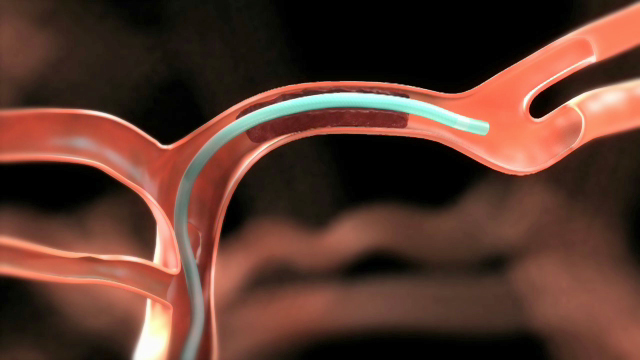 Research published online in The New England Journal of Medicine found that the addition of Medtronic's Solitaire™ Device stent thrombectomy procedure to current pharmaceutical treatment significantly reduces disability in patients suffering stroke. 