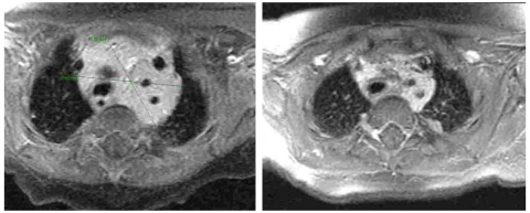 MRI scans at the level of Isabella's sternum show the rapid effect of propranolol treatment. On the left, before the drug treatment, the hemangioma tumor (crossed by green lines) was very large. On the right, after 5 days of drug treatment, the tumor had already shrunk significantly. (Photo: Business Wire)