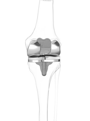 ConforMIS iTotal® customized total knee replacement (Graphic: Business Wire)