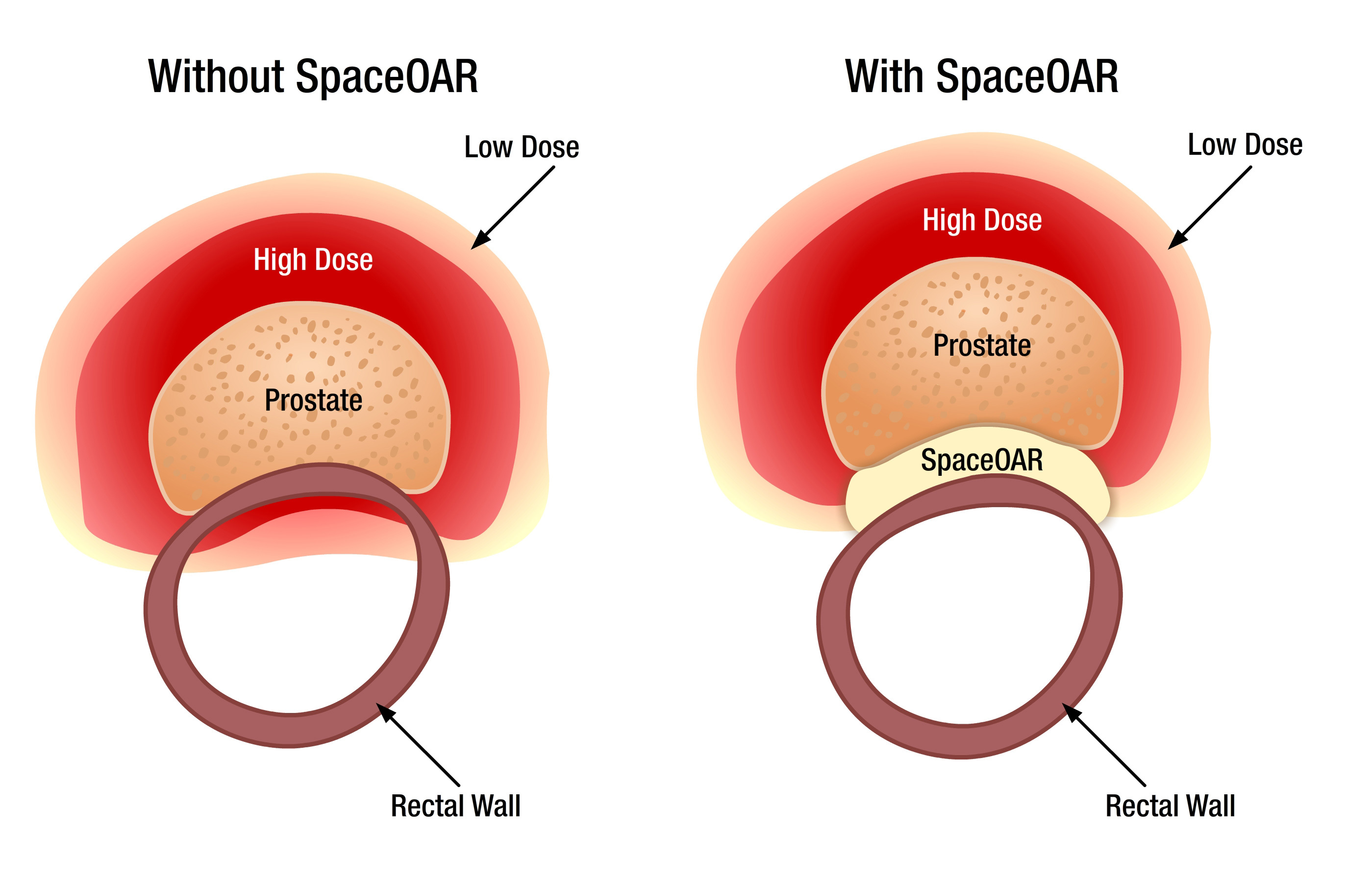 Spaceoar procedure video