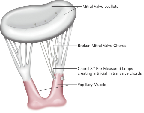 Chord-X(TM) Pre-Measured Loops for mitral chordal replacement (Graphic: Business Wire)