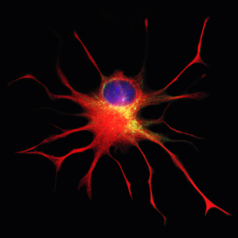 Stained Q-Cell® in culture, during differentiation, with yellow showing early progenitor characteristics, and red highlighting a protein found later in astrocytes, the cell type thought to be beneficial for ALS patients; DNA in the nucleus is highlighted in blue. (Photo: Business Wire)