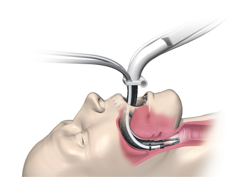 The Medrobotics Flex® Robotic System provides excellent surgical access and visualization of the mouth and throat. (Graphic: Business Wire)