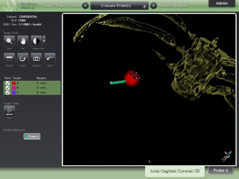 Ablation Confirmation User Interface: Probe Placement Hits Target 3D Visualization of probe (green) placed in-procedure against the identified target lesion (red) (Photo: NeuWave Medical)