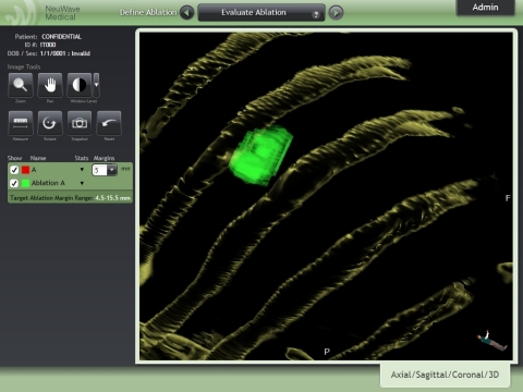 Ablation Confirmation User Interface: Confirmation of Ablation Plus Margin. 3D Visualization of target lesion post-ablation (turns green) - if any of the target lesion remains post-ablation it would appear red (Photo: NeuWave Medical)
