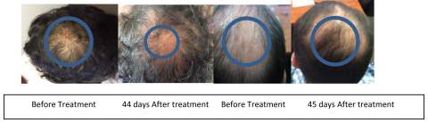 The before and after pictures of two individuals who have been using the product for 45 days. (Graphic: Business Wire)