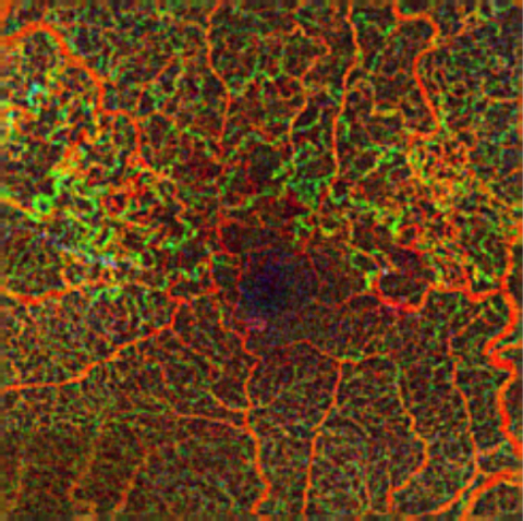 AngioPlex image of branch retinal vein occlusion (BRVO) (Photo: Business Wire)