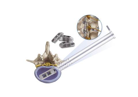 joimax EndoLIF On-Cage implant (Graphic: Business Wire)