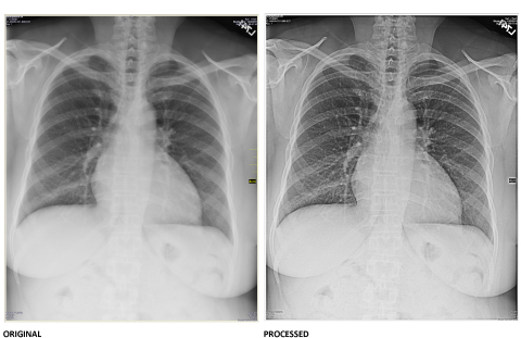 Standard x-ray image before (left) and after (right) Digital Harmonic's technology is applied. (Photo: Business Wire)