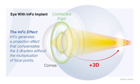 New IOL Launch - InFo by SAV-IOL Switzerland (Graphic: SAV-IOL SA 2016)