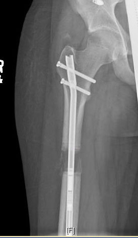 But by 2014, when his right femur was lengthened, surgeon Scott Hoffinger, MD, instead used an internal bracing device that sits entirely inside the bone and is visible only by X-ray. The X-ray image shows the region where wisps of new bone are forming during the lengthening process, which was managed by a magnet-powered bone lengthening device. This magnetic motor in Andrew's leg was removed January 21, 2016. (Photo: Business Wire)