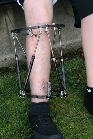 In 2010, Andrew Hirsch's lower right leg was lengthened using a bulky, uncomfortable external brace. (Photo: Business Wire)