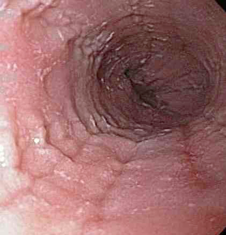 Endoscopy of patient with eosinophilic esophagitis with characteristic rings and furrows. (Photo: Business Wire)
