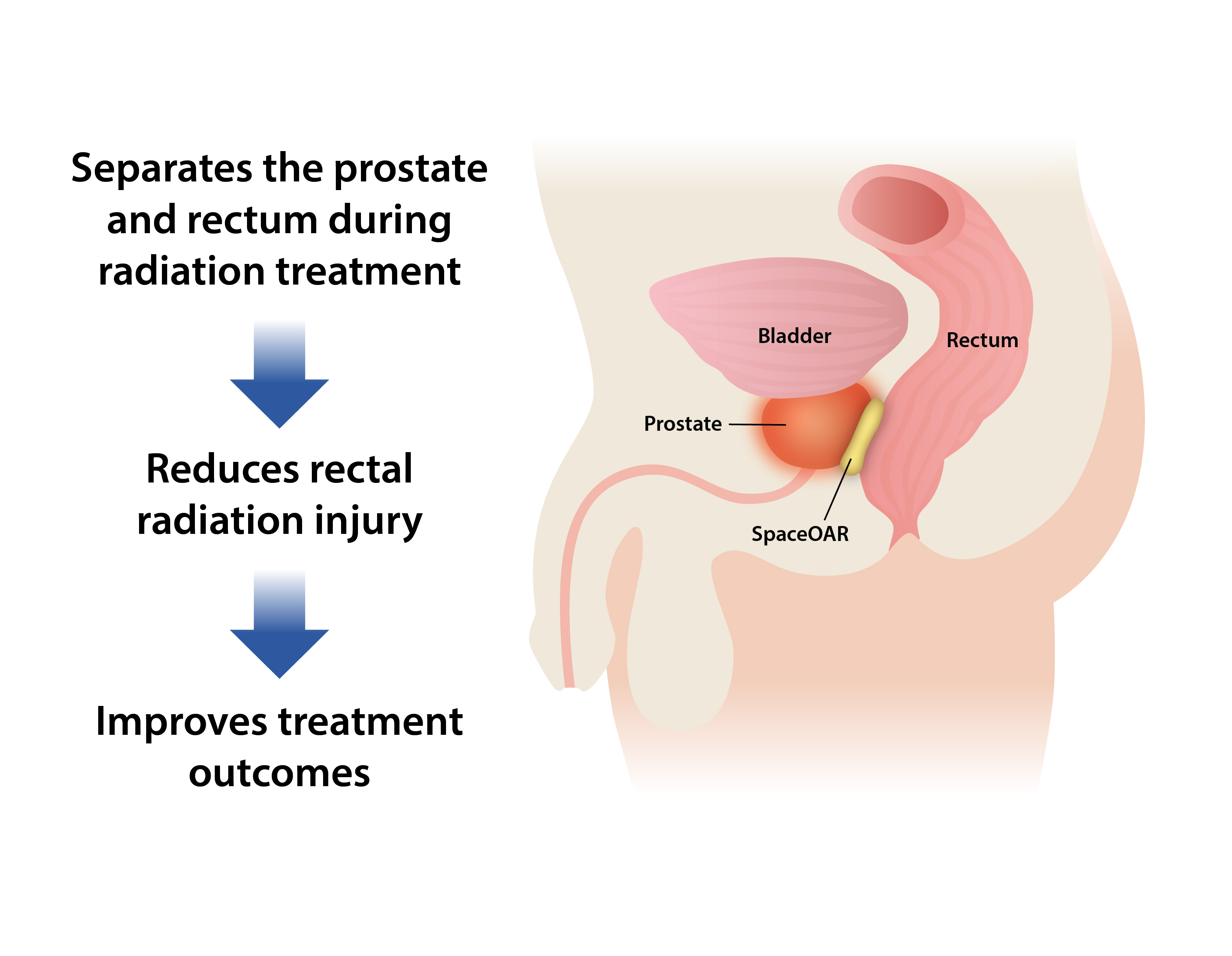 Improving Prostate Cancer Treatment with Hydrogel Spacers