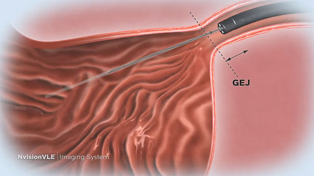 The NvisionVLE® Imaging System enables physicians to visualize tissue microstructure during a standard endoscopy procedure. The real-time, high-resolution cross-sectional images that are acquired with this technology enable gastroenterologists to evaluate tissue for potential disease that may not be visible with conventional medical imaging technologies.