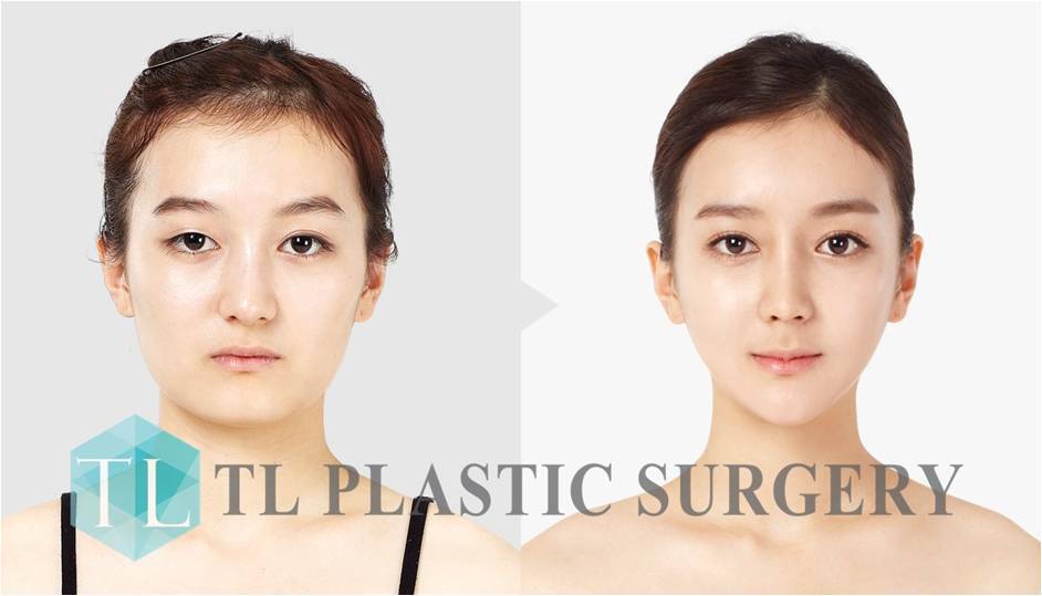 Shape, Lift, Contour the Face - Burlington Plastic Surgery