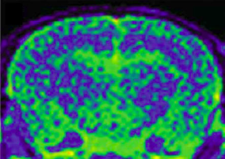 MRI image of transgenic mouse brain with ADx (Graphic: Business Wire)