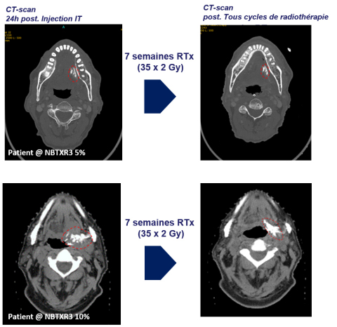 Figure : Patients traités avec NBTXR3 (à 5% et 10%), CT Scan (visualisation de NBTXR3) montrant la présence des nanoparticules du jour de l’injection jusqu’à la fin des séances de radiothérapie. 