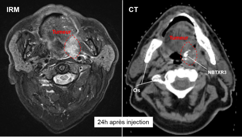 Figure : Patient traité avec NBTXR3, IRM (visualisation de la tumeur) et CT Scan (visualisation des nanoparticules) réalisé 24h après l’injection montrant la présence du produit dans la tumeur.